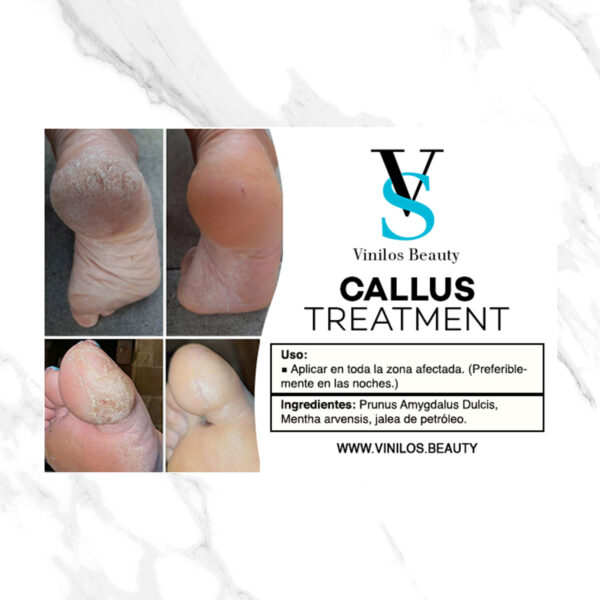 Callus Treatment, Professional Foot Care, Natural Ingredients with Prunus Amygdalus Dulcis and Mentha Arvensis - Image 2